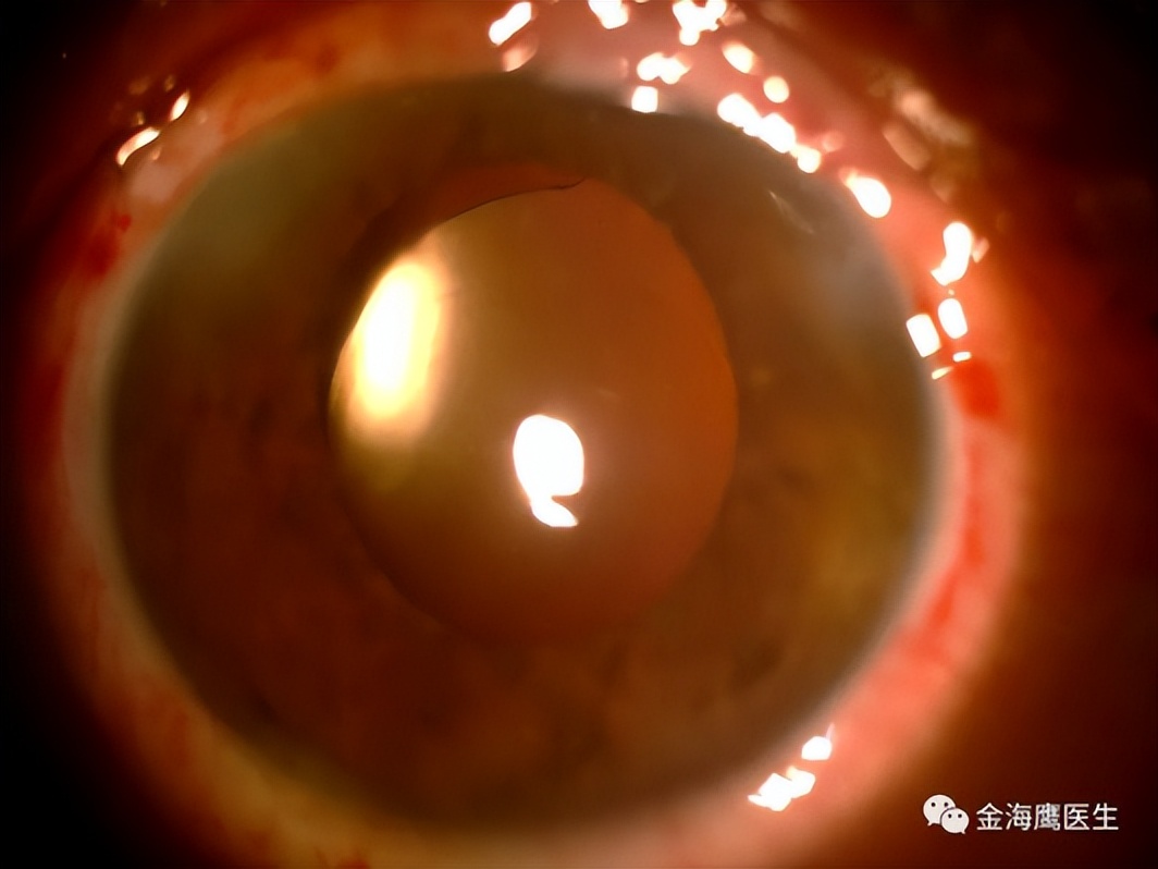 同济大学附属上海东方医院金海鹰教授：巩膜层间缝纫机技术要点