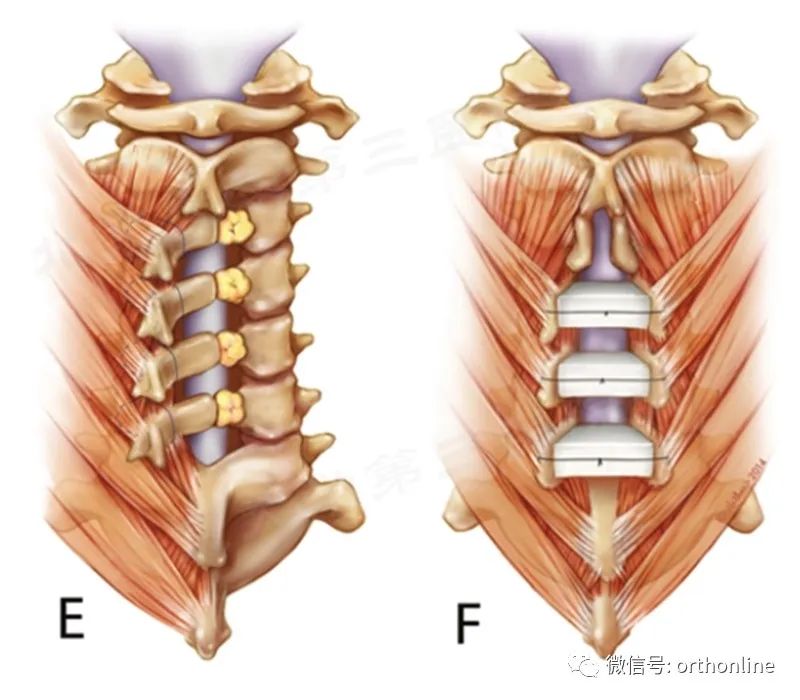 脊髓型颈椎病椎板成形术,椎间盘成形术指征