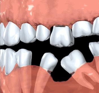 牙齿掉了对其他的牙齿有影响吗,牙齿掉了三个月没有出牙