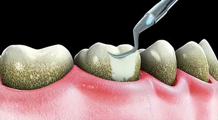 牙结石能直接抠下来吗,为什么牙结石可以用手抠出来
