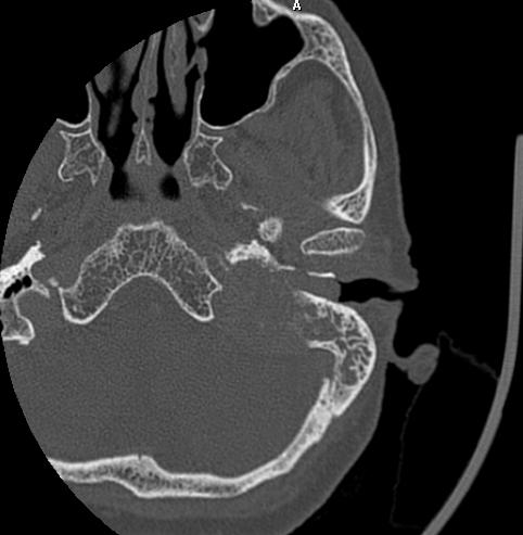 影像诊断笔记-颈静脉球瘤