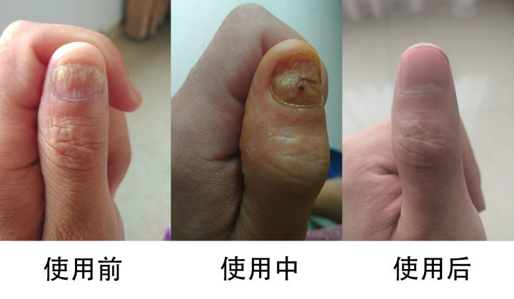 灰指甲怎样才能彻底根除用什么药,脚上灰指甲怎么才能彻底根治