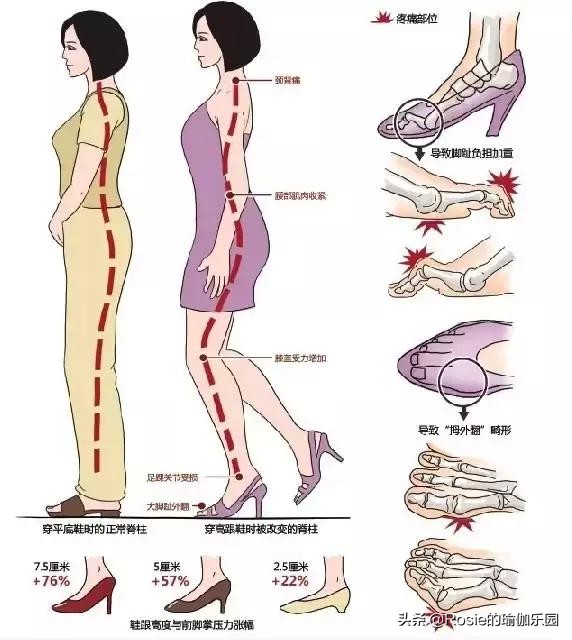 小腿外翻怎么瘦腿变成直腿,如何改善大腿外翻小腿外翻