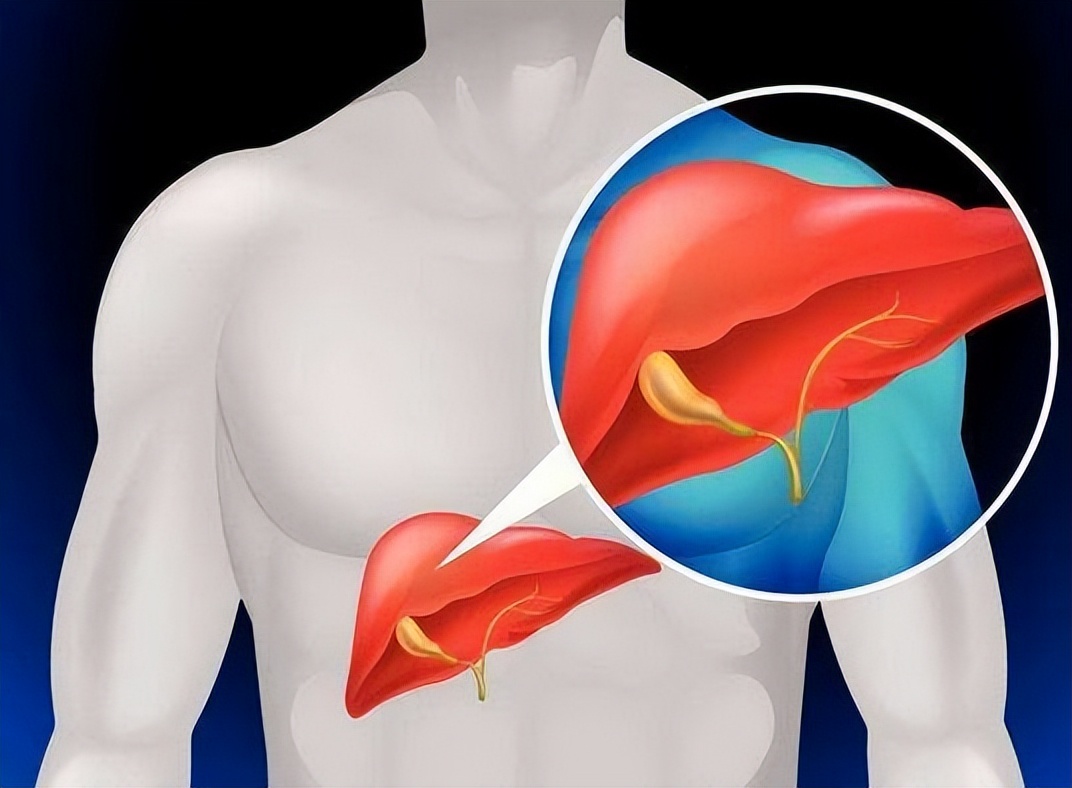肝病医生讲解胆红素高怎么办,胆红素高肝病专家
