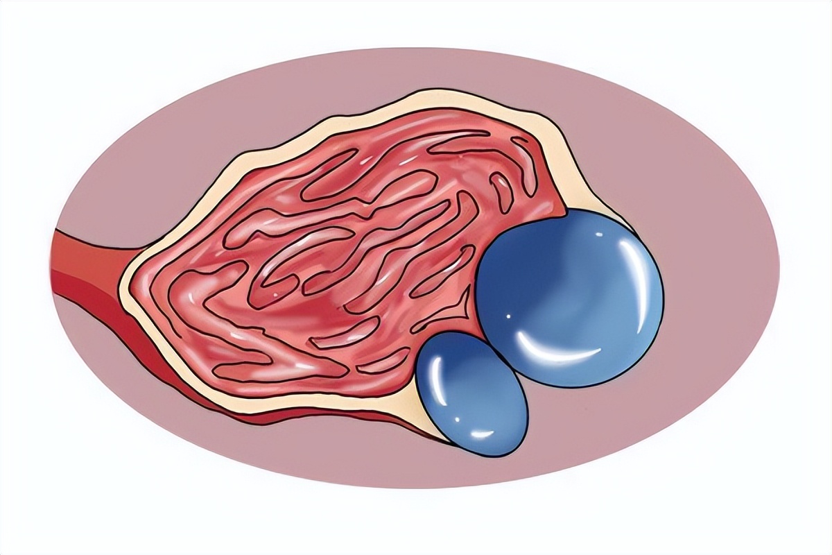 医生说有个小囊肿要注意些什么,医生治囊肿