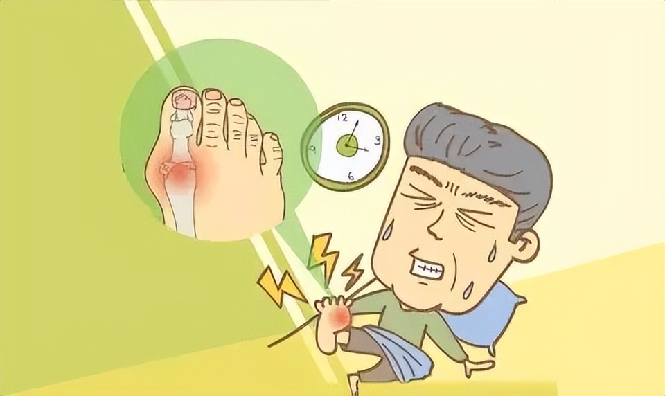 痛风好发作的部位在哪,痛风高发的人群有哪些