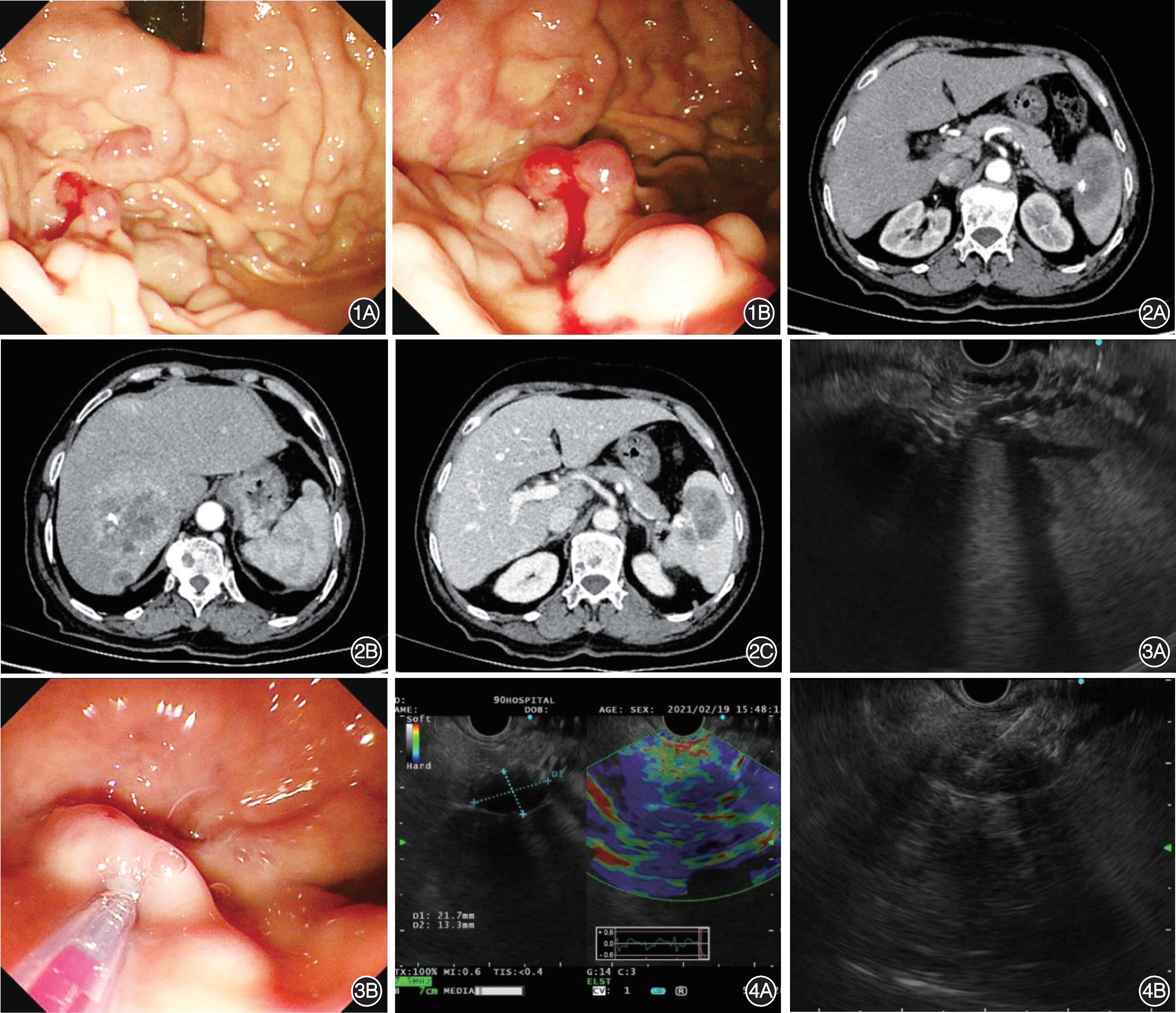 胰腺恶性肿瘤胆管出血,胰腺恶性肿瘤导致胃出血该怎么办