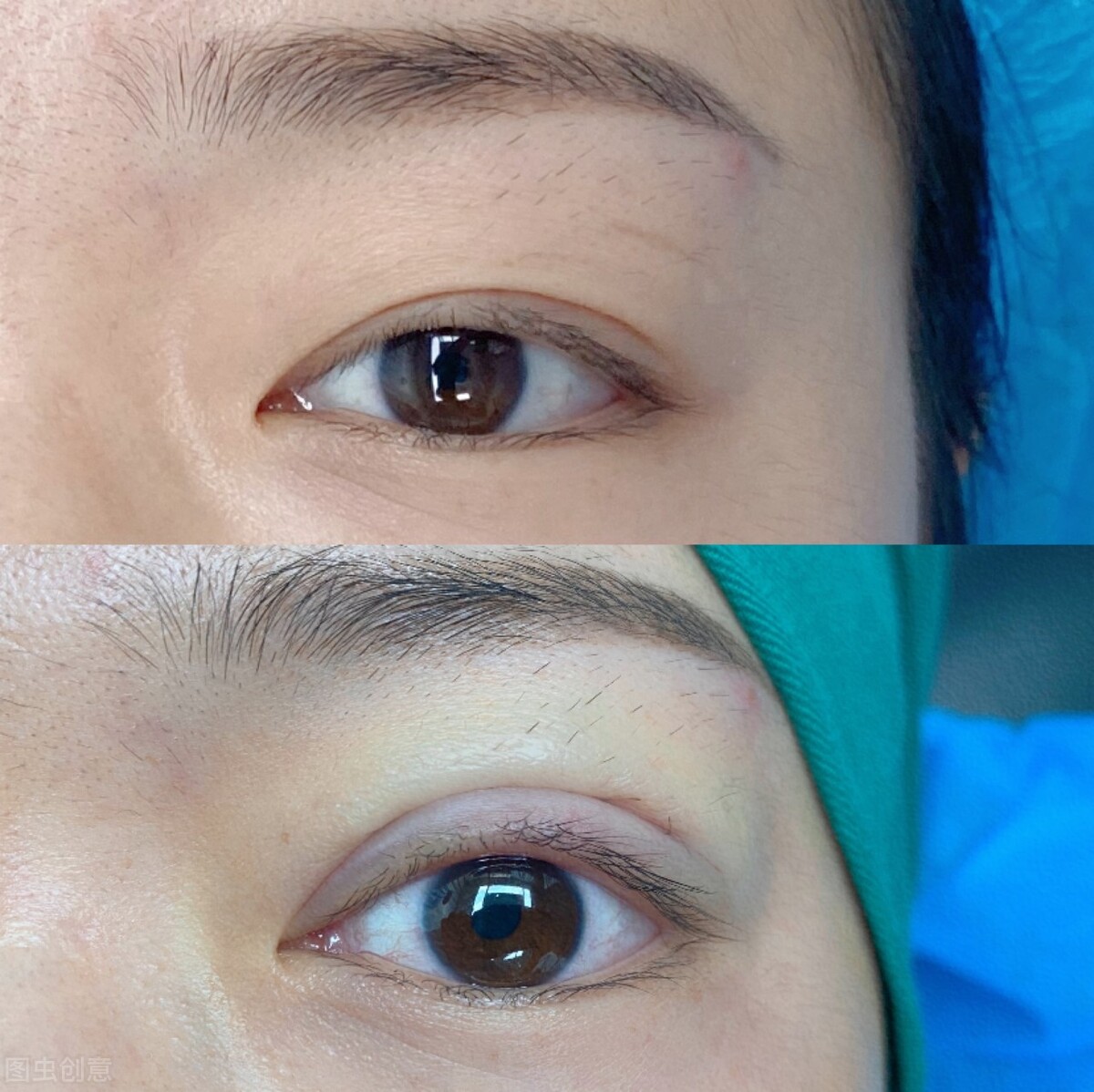 双眼皮提肌失败后几个月可以修复,割双眼皮失败了可以免费修复吗