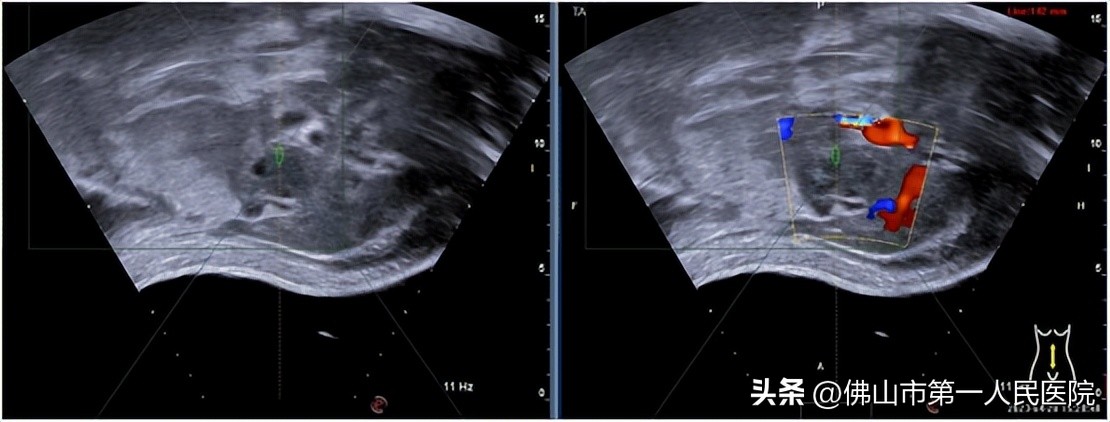 海扶刀手术治疗胰腺癌怎么样,胰腺癌海扶刀手术多长时间