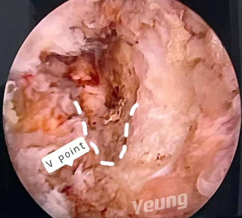 西安椎间孔镜手术治疗颈椎,西安红会医院微创