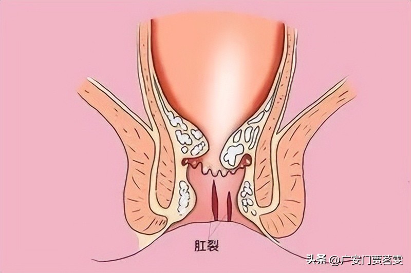 肛裂是因为什么原因造成的,肛裂都是什么情况造成的