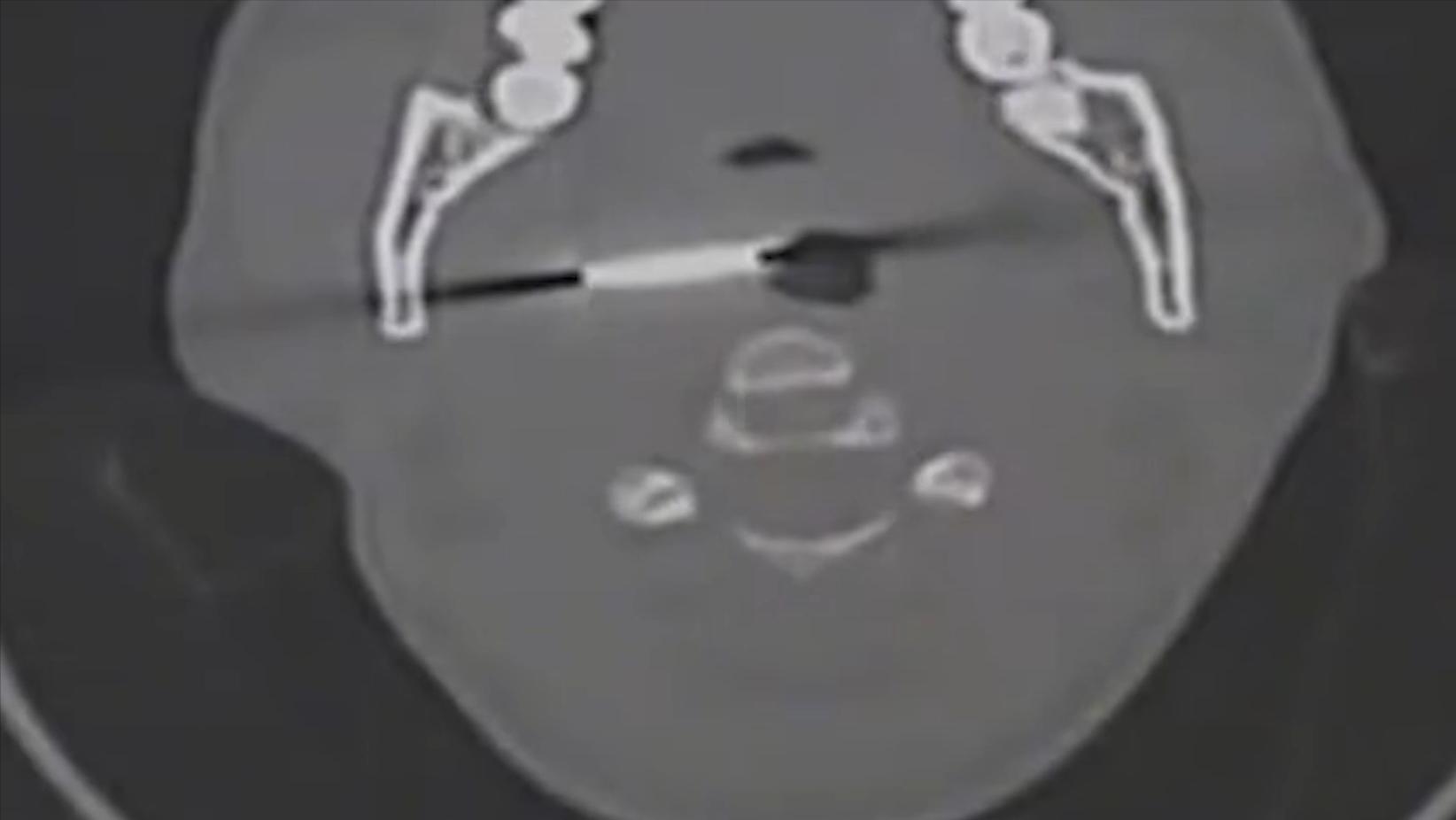 云南男子口臭手术后现在怎么样了,云南男子口臭查出了大毛病