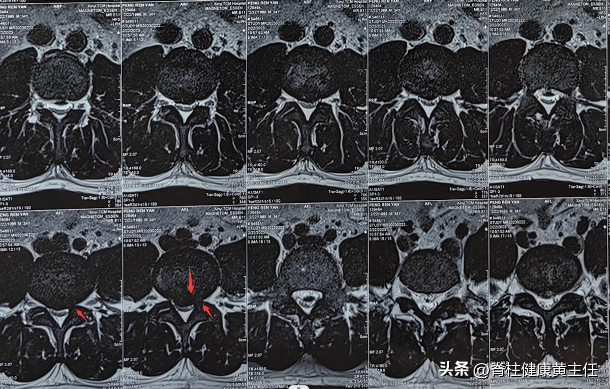 腰间盘突出压迫腿疼怎么治疗,腰间盘突出坐骨神经痛左臀酸痛