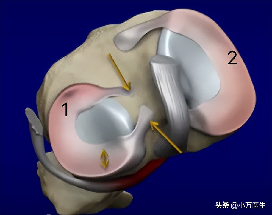 半月板后角撕裂微创手术,半月板撕裂分型