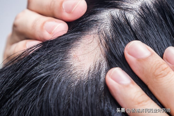 严重斑秃新药问世：Litfulo在美获批，是首个青少年可用的药物