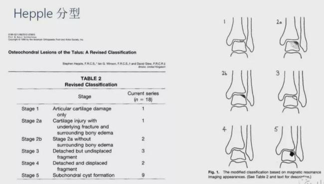 踝关节软骨损伤与踝关节炎区别,踝关节距骨软骨损伤怎么保护的