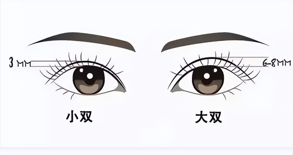 埋线双眼皮疼吗,做双眼皮手术疼吗