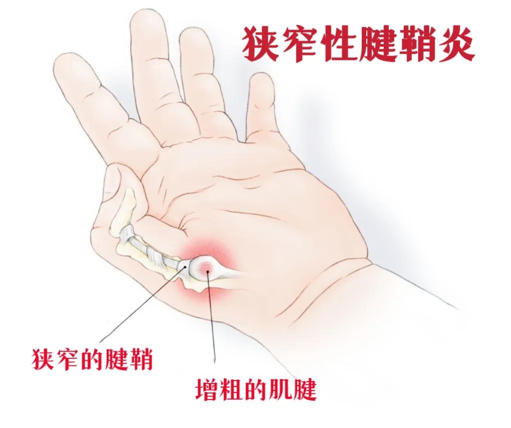 中年妇女手指腱鞘炎是怎么回事,更年期脚拇指腱鞘炎