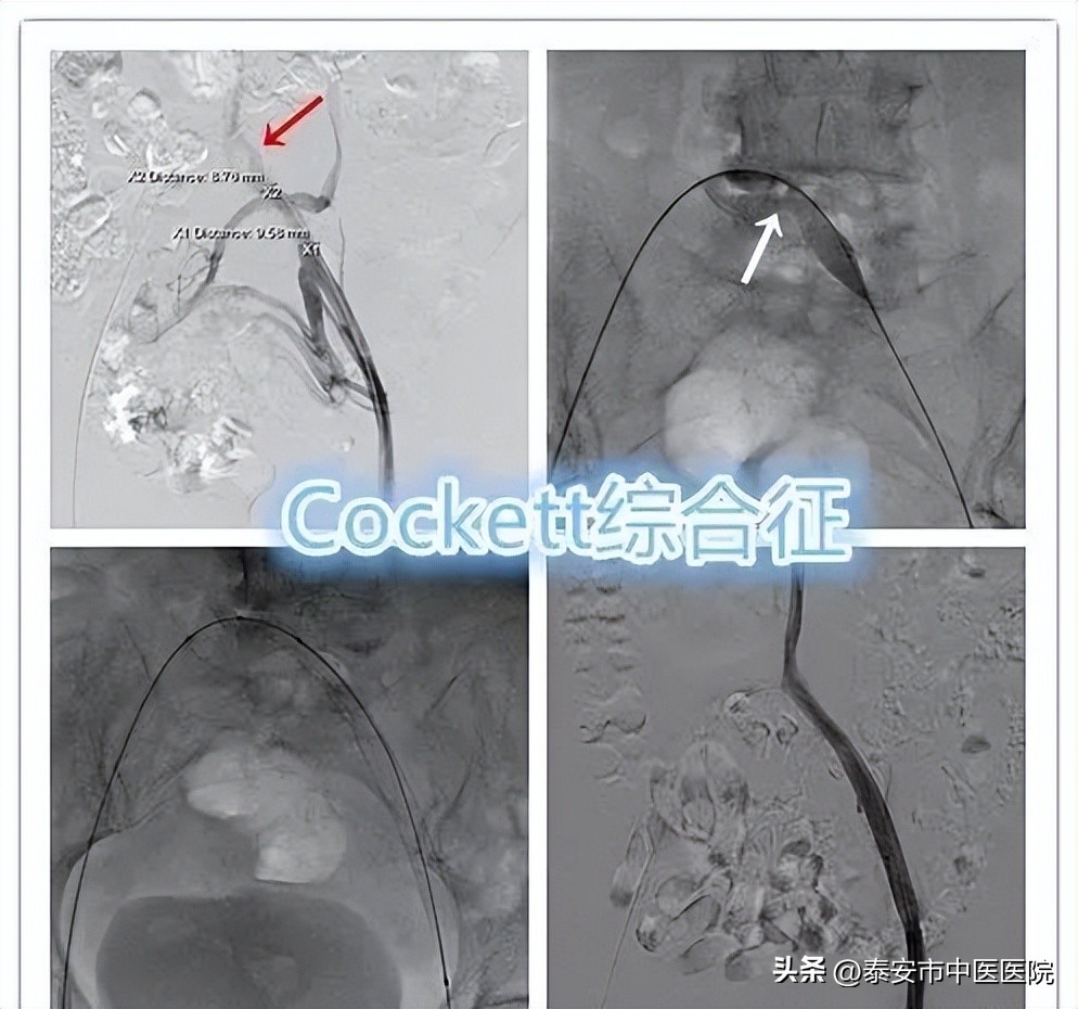 下肢静脉曲张引起的溃疡康复理疗,中医治疗下肢溃疡