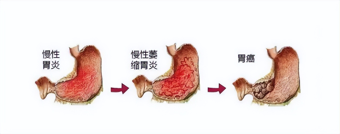 萎缩性胃炎c3伴肠化就是胃癌吗,萎缩性胃炎肠化转胃癌几率高不高