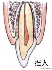 孩子换牙旧牙齿该怎么处理,小孩牙齿受伤换牙受影响吗