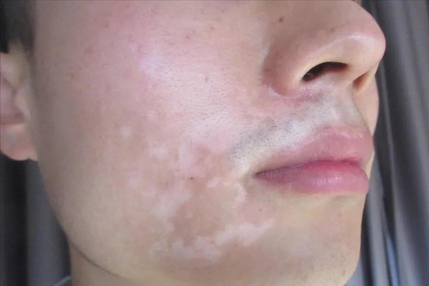 白癜风男孩患者真实记录,28岁小伙头部白癜风