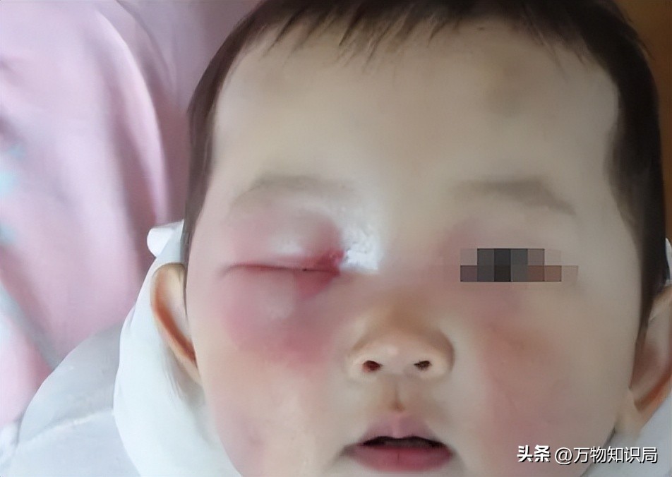 8岁男孩眼球融化荧光棒,小孩眼珠熔化视频