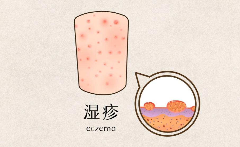 什么是湿疹湿疹是如何产生的,湿疹是什么原因造成的湿疹怎么治