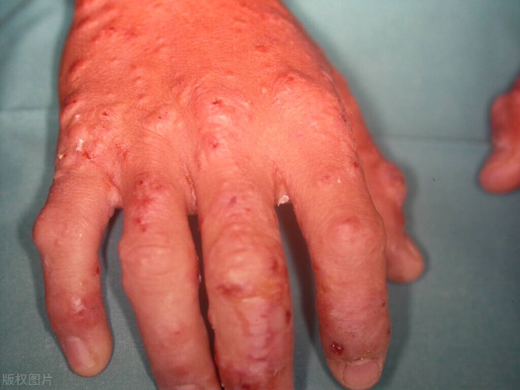 早期艾滋会出现什么皮肤病,不要错把艾滋当皮肤病