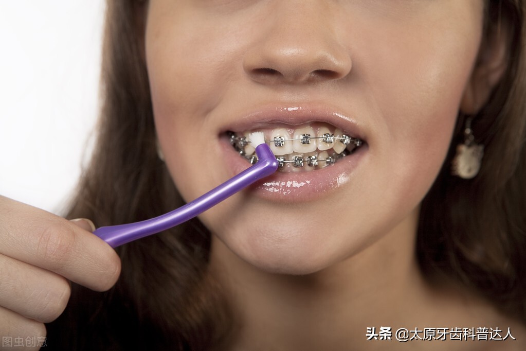 隐形矫正可以戴牙套吃饭吗,隐形牙套矫正需要戴皮筋吗