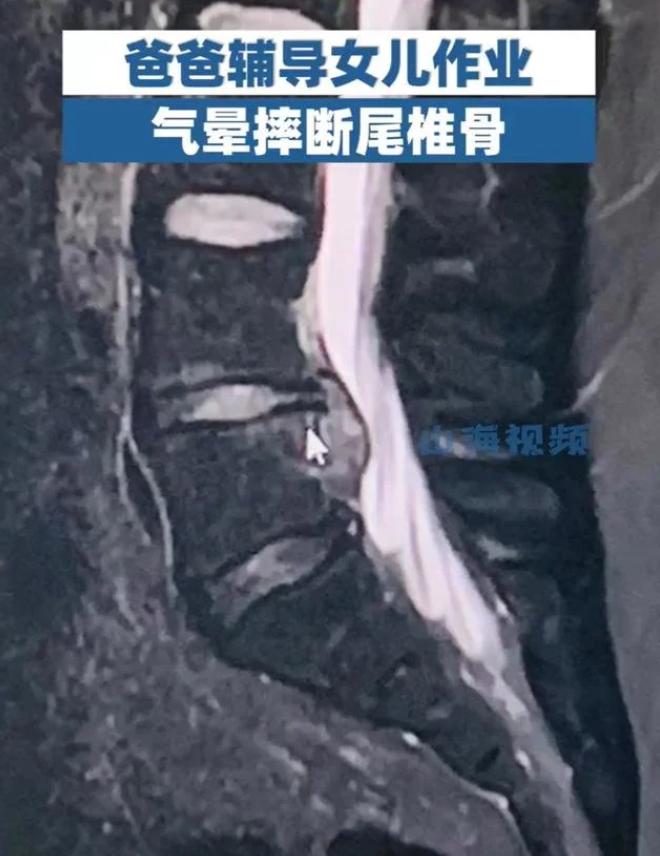 爸爸辅导女儿写作业被气哭,爸爸辅导女儿气晕摔断尾椎