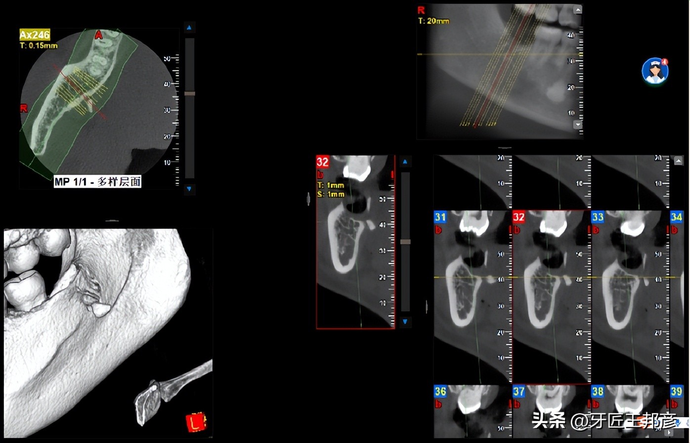智齿牙根掉入间隙,智齿自己掉了牙根还在里面怎么办