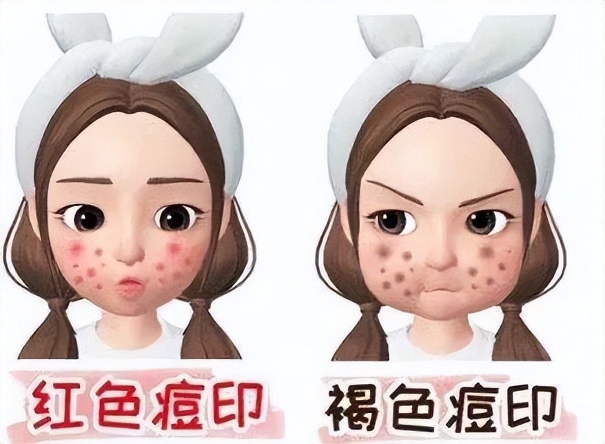 痘痘痘印痘坑改善全过程,学生祛痘痘和痘印痘坑简单的方法