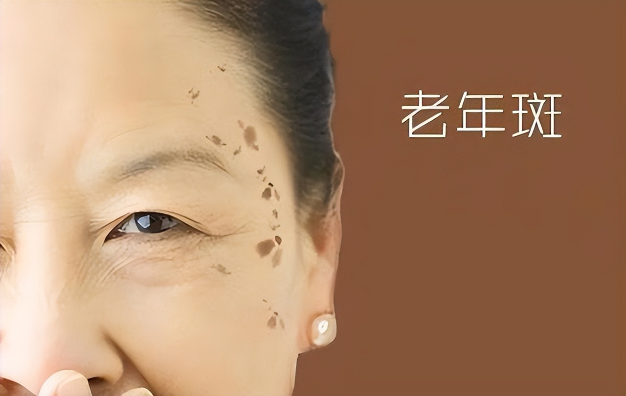 祛老年斑涂抹什么药膏有效,快速消除老年斑的小妙招红霉素