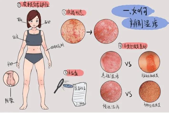 皮炎与湿疹如何鉴别及如何预防,新生儿热疹和湿疹的预防与护理