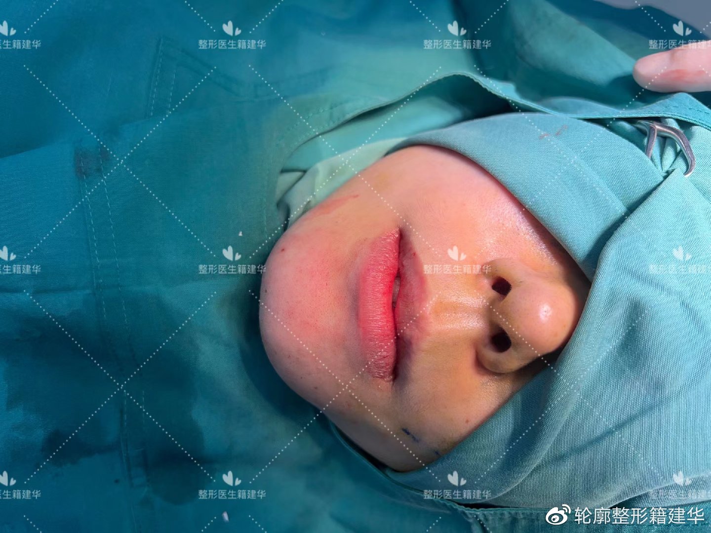 下巴后缩要怎么整形,下巴后缩做什么手术矫正