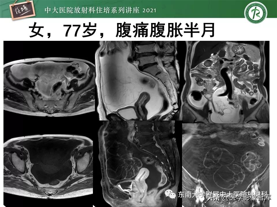 卵巢浆液性肿瘤的肉眼及镜下特征,卵巢原发性粘液性囊腺瘤