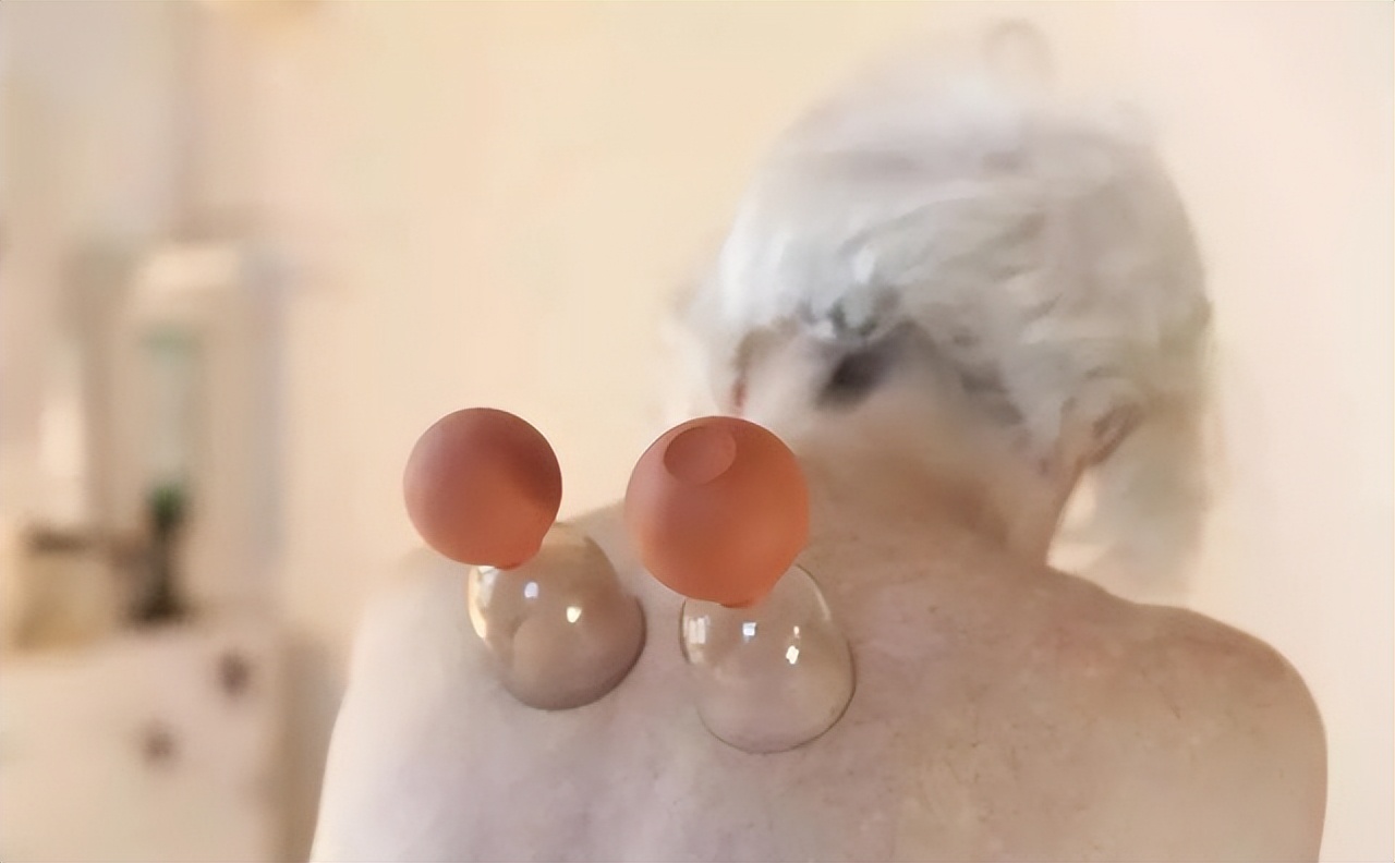 拔火罐吸出来的是湿气还是毒素,拔火罐吸出来的淤血是什么