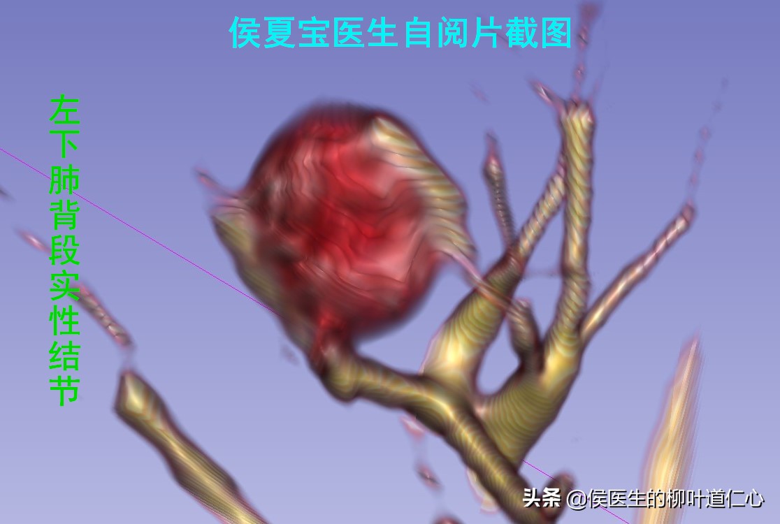 这例“被肺癌”的结节，手术不过度，但完全可以延迟在疫情后