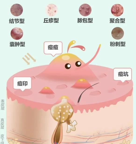 疮痈中医辨证论治,治疮疡的方子