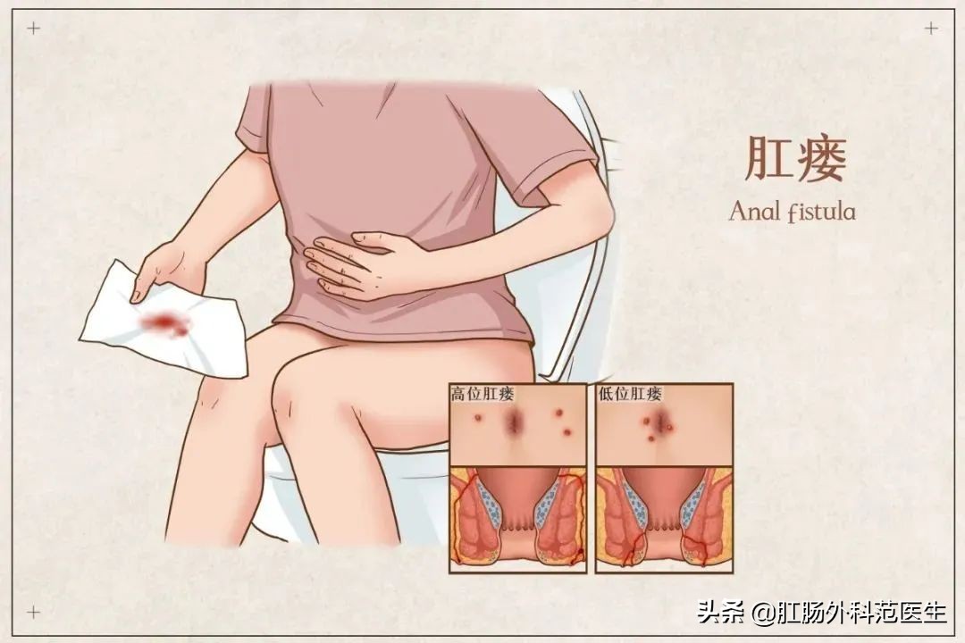 肛瘘做b超能检查出来吗,肛瘘需要做肠镜检查吗