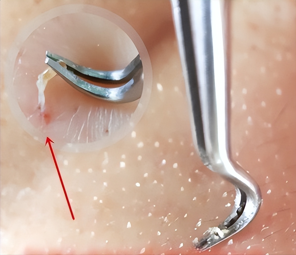 鼻子黑头感觉脏脏的,草莓黑头怎么去除最有效