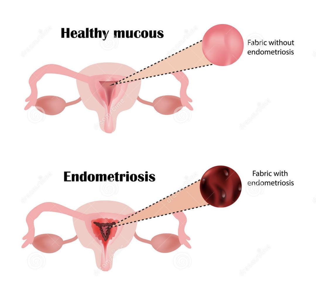 子宫内膜-成功妊娠的秘密*器武**