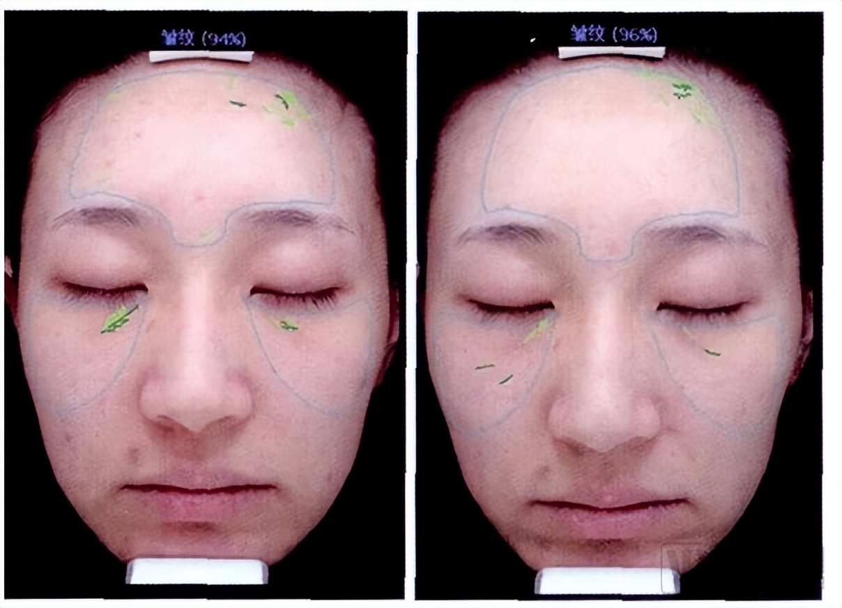 深度解读:井喷式增长下,光电医美的未来与更多可能