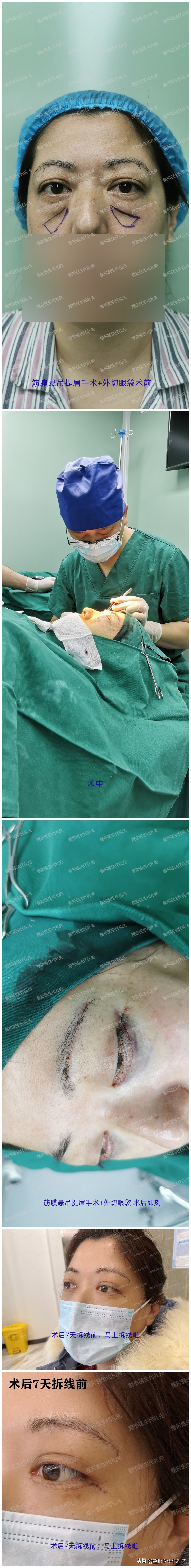 眼袋贴消除眼袋正品效果好,消除眼袋的方法有哪些