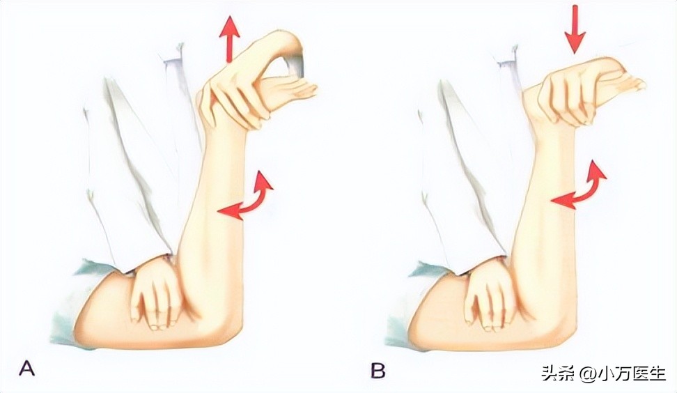 半月板后角撕裂微创手术,半月板撕裂分型