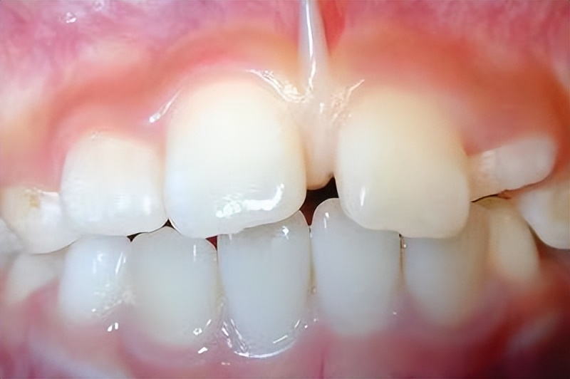 宝宝牙缝大是吃糖引起的吗,宝宝牙缝太宽了吧