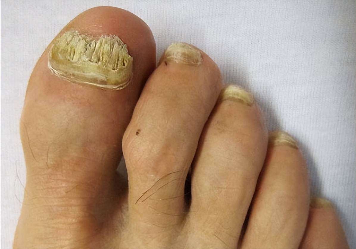 灰指甲接触的物品怎么处理,灰指甲周围皮肤都坏了如何处理