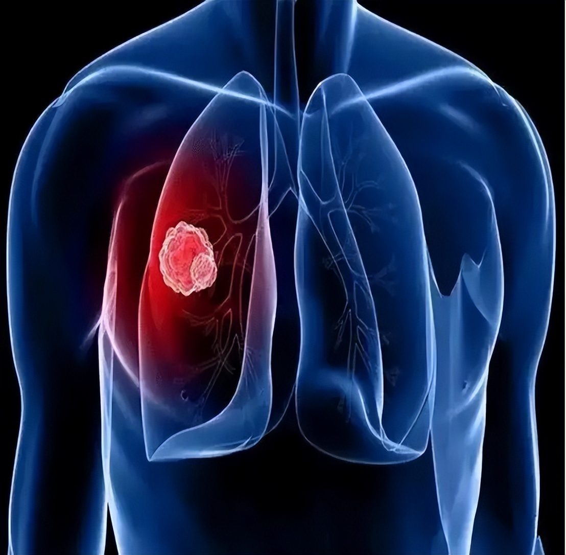 癌症根本不用治治好的都是误诊,癌症不用治治好的都是误诊