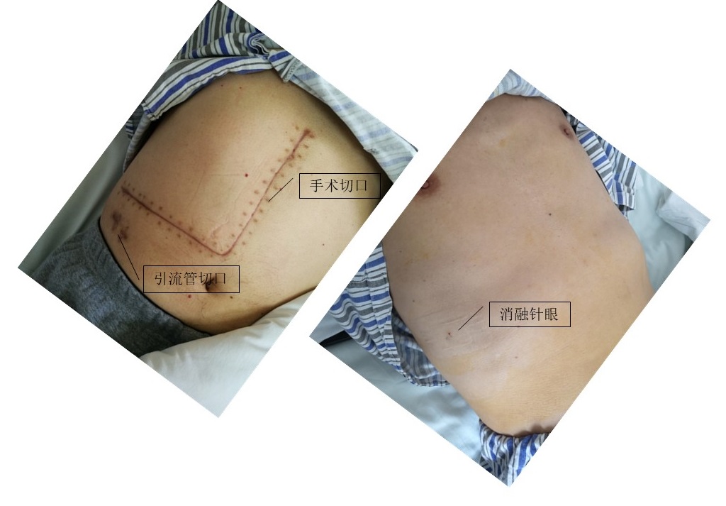 肿瘤局部消融的病历举例